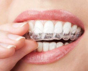 Enten Vierde Voorrecht Wil je graag wittere tanden door Tandartspraktijk Kies & Co